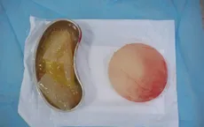 Xử lý thành công ca vỡ túi ngực hy hữu trong thai kỳ