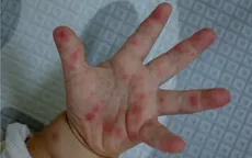 Bệnh tay chân miệng diễn biến phức tạp, các cơ sở giáo dục mầm non ở TP Hồ Chí Minh cần làm gì?