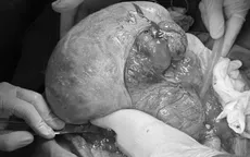 Phẫu thuật thành công khối u nặng 6kg