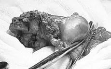 Cứu bệnh nhân viêm ruột thừa ẩn trong lòng manh tràng hiếm gặp