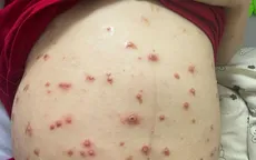 Thủy đậu khi mang thai: Nguy cơ cho cả mẹ và thai nhi