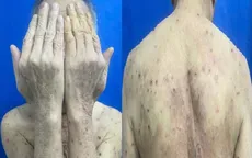 Ngứa kéo dài ở người cao tuổi có thể là bệnh da tự miễn nguy hiểm