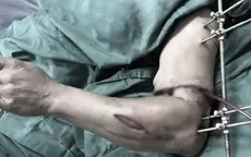 Nối thành công cánh tay đứt lìa trong "giờ vàng"