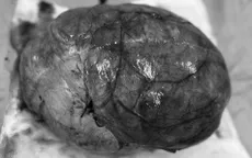 Phát hiện u buồng trứng 36cm ở bệnh nhân 23 tuổi