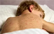 Dịch sởi bùng phát tại Mỹ 