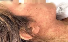 Sởi ở người lớn: Nữ bệnh nhân biến chứng nặng do chưa tiêm vaccine