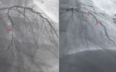 Cứu sống bệnh nhân 96 tuổi nhồi máu cơ tim cấp nguy kịch