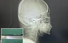 Hy hữu người đàn ông Trung Quốc sống 8 năm với chiếc đũa kim loại mắc trong cổ họng