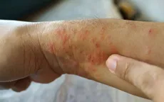 Số ca tử vong tăng, Thái Lan cảnh báo bùng phát dịch “sốt đất” nguy hiểm