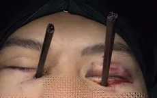 Cấp cứu nam thanh niên bị 2 chiếc đũa đâm sâu vào mắt