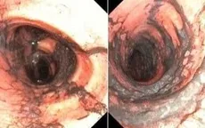 Cứu sống vợ chồng trẻ bị ngạt khói, bỏng khí quản nặng