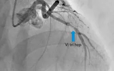 Nguy kịch vì tái hẹp trong stent do không duy trì thuốc theo chỉ định
