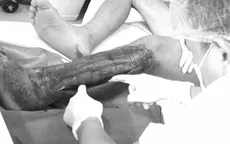 Hoại tử nguy kịch do sai lầm khi xử lý vết thương tại nhà