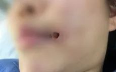 Cảnh báo biến chứng muộn sau tiêm filler