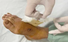 Cảnh báo nguy cơ rắn độc cắn tăng cao mùa rắn sinh sản