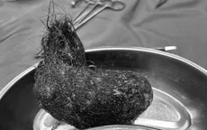 Lấy búi tóc lớn trong dạ dày bé gái 7 tuổi