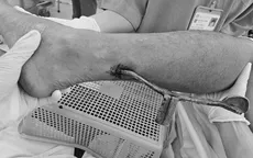 Người đàn ông nhập viện với cần số xe máy cắm vào chân
