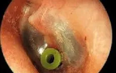 Viêm tai giữa ứ dịch - mối đe doạ thính lực và ngôn ngữ của trẻ