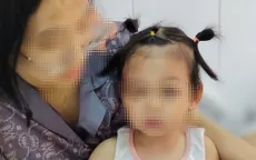 Cấp cứu kịp thời, bảo toàn khuôn mặt cho bé gái bị chó cắn
