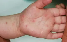 Hà Nội ghi nhận nhiều ca tay chân miệng trong tuần qua