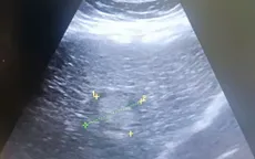 Phát hiện ung thư gan muộn vì không khám định kỳ