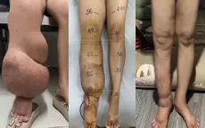 Bệnh nhân phù bạch mạch cải thiện rõ sau ghép hạch bạch huyết