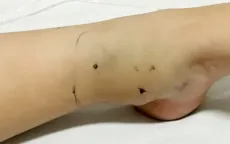 Mùa rắn sinh sản, nguy cơ rắn độc cắn gia tăng