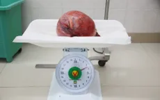 Cắt khối u xơ tử cung khổng lồ cho bệnh nhân 53 tuổi