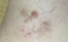 Số ca mắc ký sinh trùng gia tăng do thói quen ăn uống