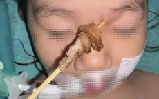 Nguy hiểm: Bé gái nhập viện với que xiên thịt đâm xuyên từ mũi lên hốc mắt