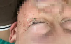 Cảnh báo chấn thương mắt do móc câu cá ở trẻ nhỏ
