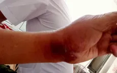 Cảnh báo nguy cơ nhiễm trùng, nhiễm độc nặng khi tiếp xúc với côn trùng độc