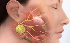 Nhận biết sớm quai bị để tránh biến chứng
