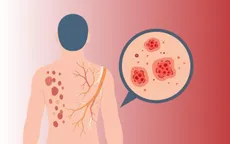 Bệnh Zona thần kinh: Nguyên nhân, triệu chứng và cách phòng ngừa