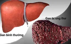 Người thuộc nhóm nguy cơ cao mắc ung thư gan cần làm gì?