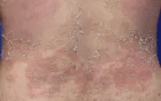 Thuốc sinh học mới giúp kiểm soát vảy nến thể mủ