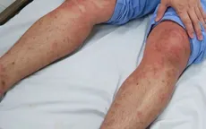 Cẩn trọng với mối nguy phản vệ do côn trùng đốt mùa hè