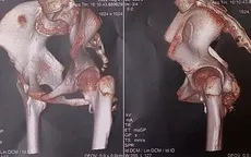 Phát hiện hội chứng "người hóa đá" thể hiếm ở một bé gái 12 tuổi
