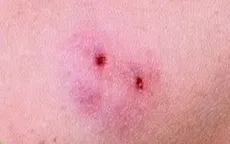 Nhiều người nhập viện vì rắn cắn mùa thu hoạch