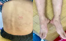 Ban nhiễm khuẩn ở trẻ em: Đừng chủ quan khi trẻ nổi ban, ngứa kéo dài