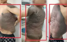 Khối u như "mai rùa" đeo bám bé trai suốt 7 năm