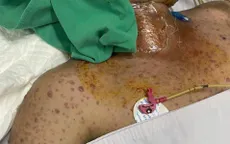 Thủy đậu có thể đe doạ tính mạng nếu biến chứng nặng