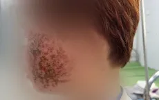 Eczema Herpeticum - đừng nhầm với viêm da thông thường