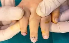 Kẹp cửa - tai nạn thường gặp gây chấn thương đầu ngón tay trẻ nhỏ