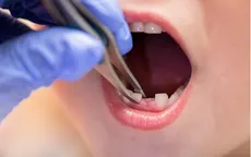 Đừng chờ thay hết răng mới chỉnh nha