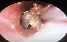 Côn trùng vào tai, xử trí sai dễ nguy hiểm