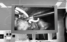Dị vật "lạc chỗ" trong ổ bụng: Đừng chủ quan với những cơn đau kéo dài