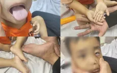 Trẻ thiếu máu nặng vì chỉ uống sữa, biếng ăn kéo dài