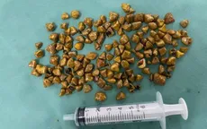 Hàng trăm viên sỏi trong túi mật người bệnh 39 tuổi
