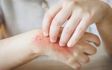 Cách nhận biết và phòng tránh bệnh về da thường gặp mùa hè